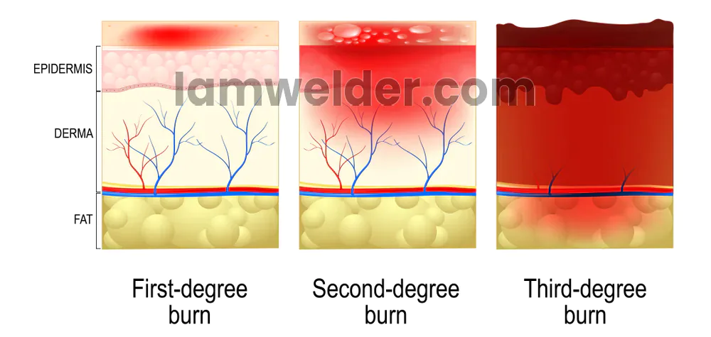 first second and third degree burn comparison